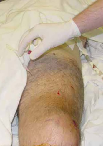 Thigh Compartment Syndrome, Presentation and Complications