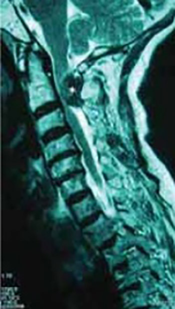 Extramedullary Intradural Spinal Tumors: a Review of Modern Diagnostic and Treatment Options and a Report of a Series