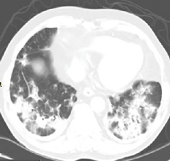 Acute Respiratory Distress Syndrome: Insights Gained from Clinical and Translational Research