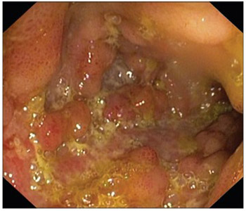 Therapeutic role of methotrexate in pediatric Crohn’s disease