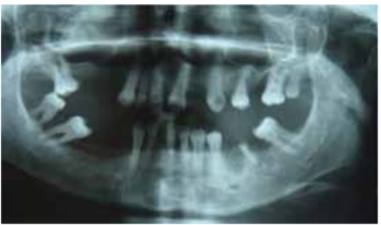 Implant Supported Prosthesıs in a Patıent wıth Progerıa: Case Report
