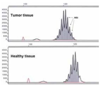 Molecular Analysis: Microsatellite Instability and Loss of Heterozygosity of Tumor Suppressor Gene in Hereditary Non-Polyposis Colorectal Cancer (HNPCC)
