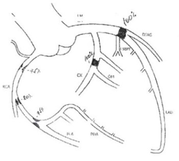 Collateral Function in Patients with Coronary Occlusion Evaluated by 201Thallium Scintigraphy