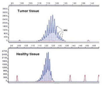 Microsatellite Instability and Loss of Heterozygosity of Tumor Suppressor Genes in Bosnian Patients with Sporadic Colorectal Cancer