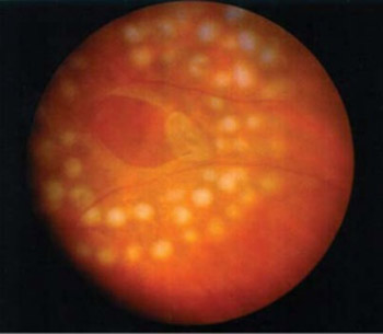 Correlation Between Refraction Level and Retinal Breaks in Myopic Eye