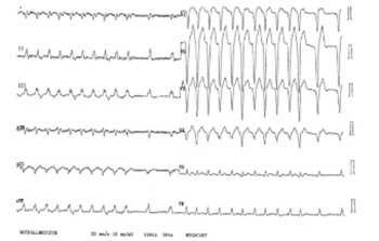 Cardiac Sarcoidosis Mimicking Takotsubo Syndrome