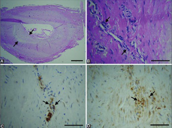 Immune cells and vasa vasorum in the tunica media of atherosclerotic coronary arteries