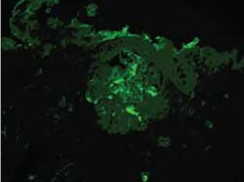 Direct Immunofluorescence and Immunohistochemistry in Diagnostics of Glomerulonephritis