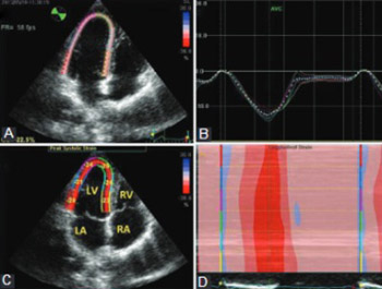 Left ventricular mechanics in Behcet’s disease: A speckle tracking echocardiographic study
