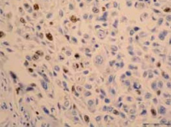 Non-Small Cell Lung Carcinoma: Cyclin D1, bcl-2, p53, Ki-67 and Her-2 Proteins Expression in Resected Tumors