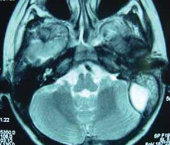 Acute Mastoiditis in Children: Susceptibility Factors and Management