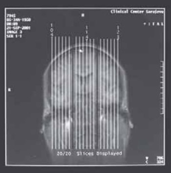 Detection of the Hippocampal Formation Asymmetry in Patients With Posttraumatic Stress Disorder