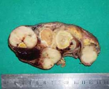 Testicular Metastasis of Gastrointestinal Stromal Tumor of the Jejunum