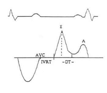 Left Venticular Diastolic Dysfunction in Essential Hypertension