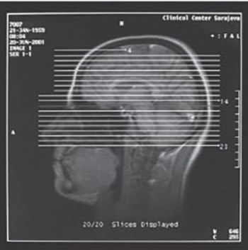 Observing the Asymmetry of Amygdaloid Complex in Patients with Complex Partial Attacks