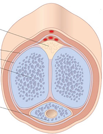 Surgical Treatment and Complications of Penile Fractures