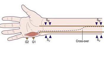 Martin-gruber Anastomosis and Transposition in Cubital Tunnel