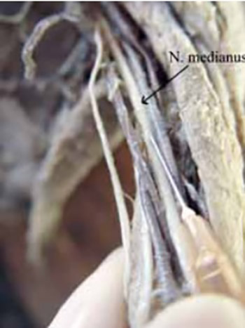 Injection Pressure as a Marker of Intraneural Injection in Procedures of Peripheral Nerves Blockade