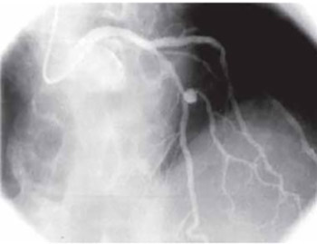 Treatment of Left Anterior Descending Artery Aneurysm