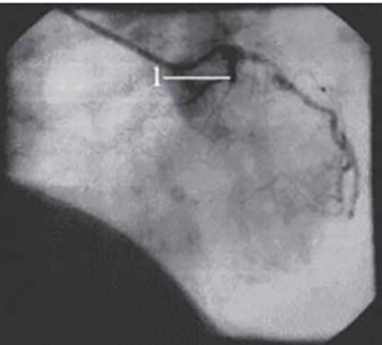 The Role of Collateral Circulation in Preserving Myocardial Function