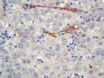 Cyclooxygenase-2 Expression Determines Neoangiogenesis in Gallbladder Carcinomas