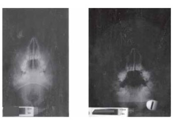 Azythromicin Versus Amoxicillin-clavulanate in the Treatment of Acute Sinusitis in Children