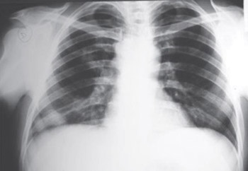 A Case of T/null Anaplastic Large Cell Lymphoma Arising in Lung