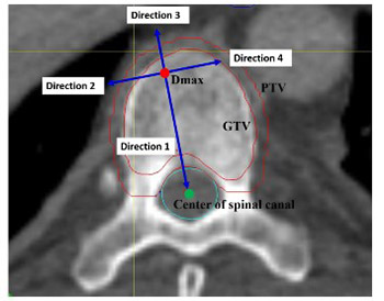 Dose fall-off during the treatment of thoracic spine metastasis with CyberKnife stereotactic body radiation therapy (SBRT)