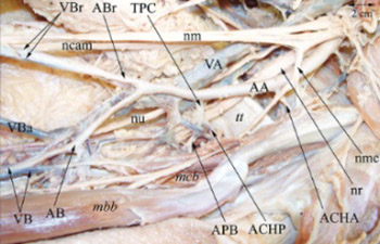 A coincidental variation of the axillary artery: the brachioradial artery and the aberrant posterior humeral circumflex artery passing under the tendon of the latissimus dorsi muscle