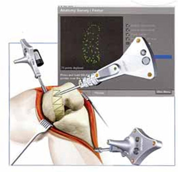 Computer Assisted Orthopaedic Surgery – CAOS