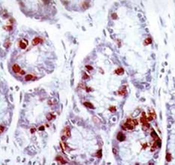 Expression of p53, bcl-2, and ki-67 Proteins in the Inﬂammatory Regenerative and Dysplastic Epithelial Lesions of Flat Colonic Mucosa