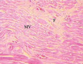 Morphologic Findings of the Ischemic Myocardium