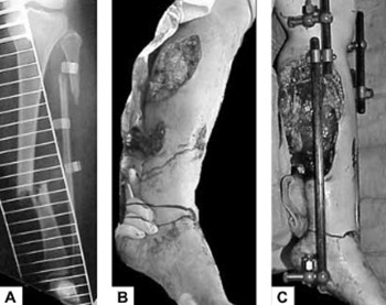 Management of Open Fractures