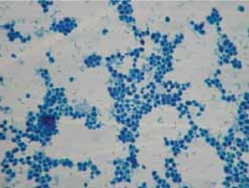 Bacterial aggregation in infected root canal