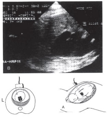 Foetal echocardiography