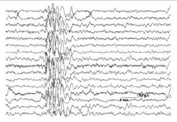 Posttraumatic seizures - prevention or not