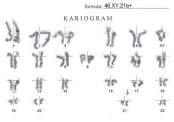 Cytogenetic findings at Down syndrome and their correlation with clinical findings