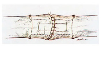 Updates in Flexor Tendon Repair at Zone II