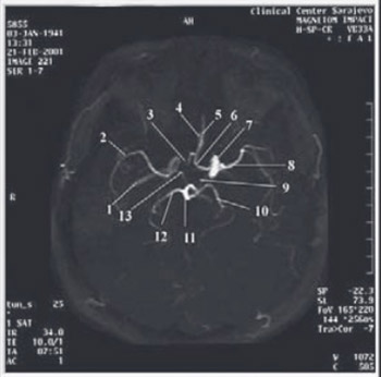 Angiography Analysis of Variations of the Posterior Segment of the Circle of Willis