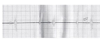 Heart Murmur and Anaemia in the Pediatric Population