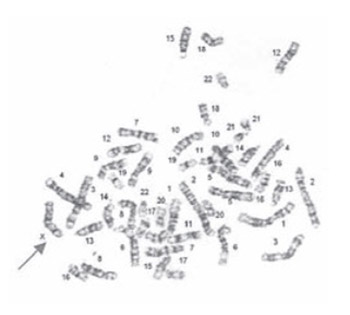 Cytogenetics findings at Turner Syndrome and their correlation with clinical findings