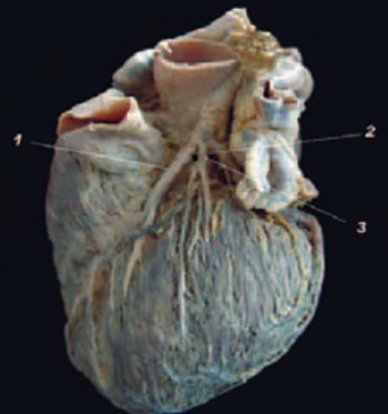 Branching of Main Trunk of Left Coronary Artery and Importance of Her Diagonal Branch in Cases of Coronary Insuficiency