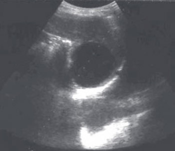 Modified Pair Technique for Treatment of Hydatid Cysts in the Spleen