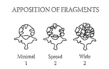 Treatment Options for Thoracolumbar Spine Fractures