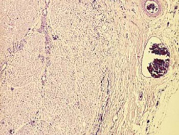 Histological changes of the sciatic nerve in dogs after intraneural application of lidocaine--relation to the established application pressure