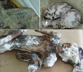 Histological observations on adipocere in human remains buried for 21 years at the Tomašica grave-site in Bosnia and Herzegovina
