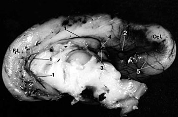 Study of the changes in the position and the pattern of changes of the brain arteries in fetuses and full-term stillborns