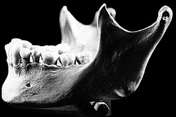 Clinical and anatomical study of the human mental foramen