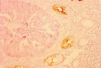 Anti-cytokeratin 7: a positive marker for epithelial dysplasia in flat bowel mucosa