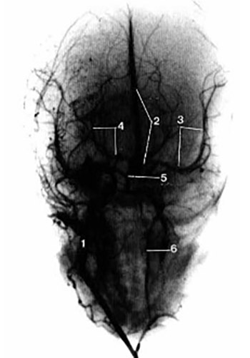 Changes in blood vessels in fetuses 4 to 9 months intrauterine life old by postmortem angiography method